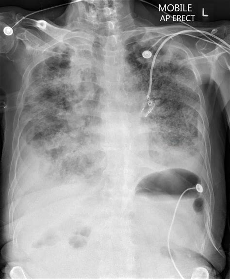 Pulmonary Nodules and Masses | Chest X-Ray - MedSchool