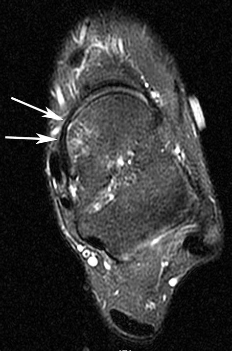 MRI of Spring Ligament Tears | AJR