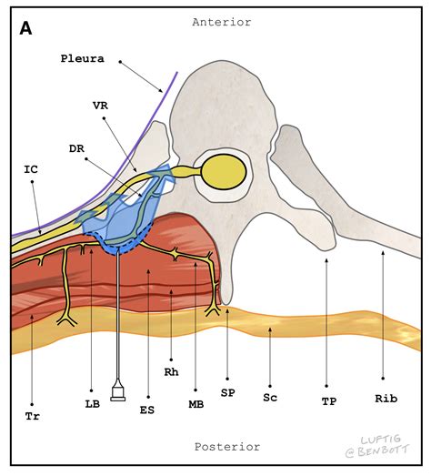 ERECTOR — Highland EM Ultrasound Fueled pain management