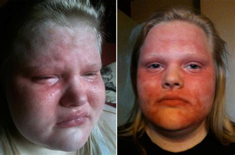 Allergic to the sun: Teen hates heatwave because she gets agonising ...