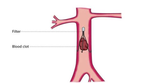 Treating Blood Clots In Your Legs – Page 4 – Entirely Health