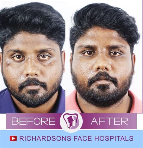 facial scar revision treatment cost – Richardson's Plastic Surgery Hospitals