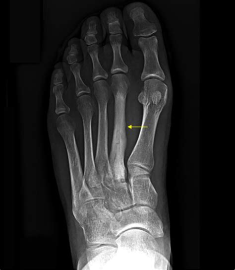 What is a hairline fracture? - Podiatry First