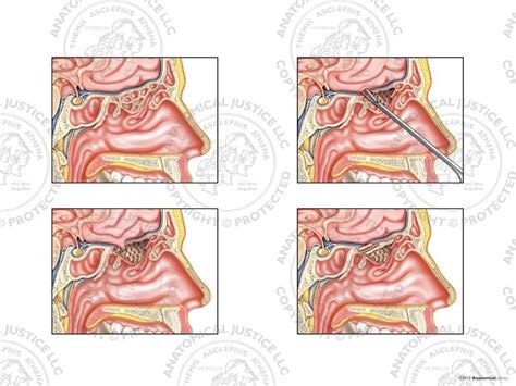 Nasal Endoscopic Sinus Surgery