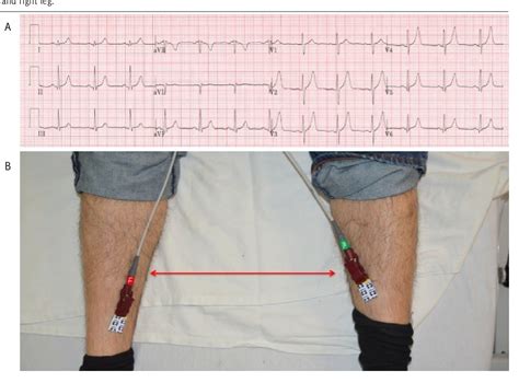 Figure 8 from Common ECG Lead Placement Errors. Part I: Limb Lead Reversals | Semantic Scholar