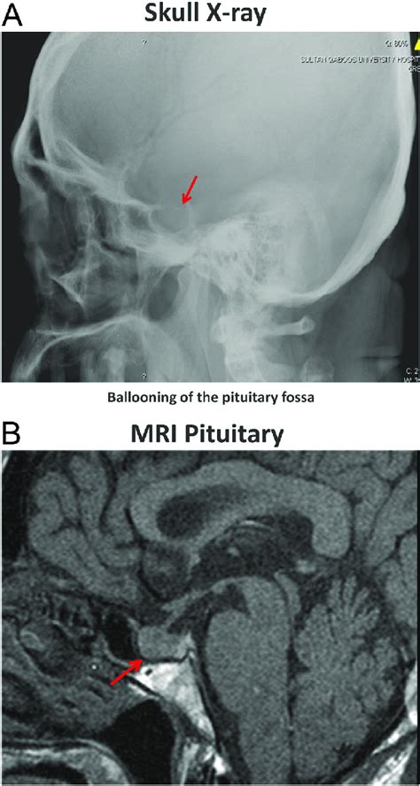 (A) Skull X-ray showing ballooning of the pituitary fossa. (B) MRI ...