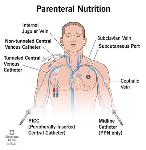 Parenteral Nutrition: What it Is, Uses & Types