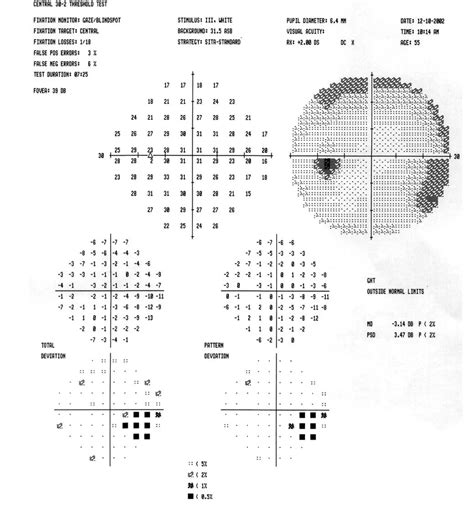 Visual fields - American Academy of Ophthalmology