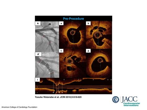 Yusuke Watanabe et al. JCIN 2016;9: - ppt download