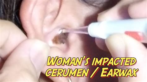 Woman's Impacted Cerumen / Earwax Removal - YouTube