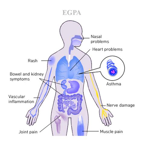 EGPA - Vasculitis Stichting