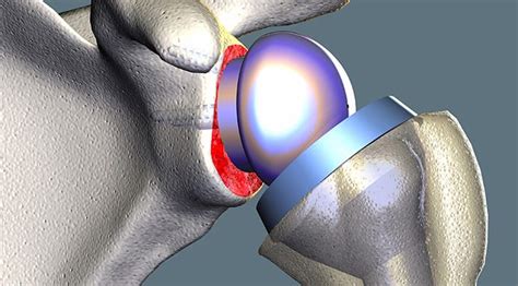 Knowing More about Best Orthopedic Surgeon San Diego | New Era Spine ...