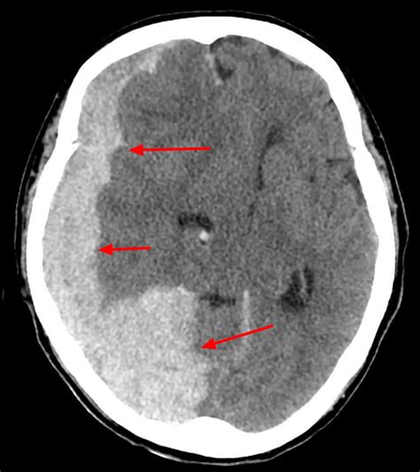 Tentorial Subdural Hematoma Subdural Hematoma What Causes Dementia | The Best Porn Website