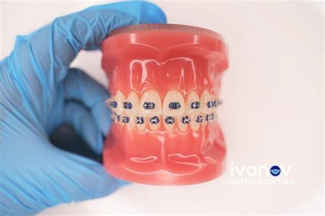 Miami Orthodontist | Best Orthodontist Miami FL | IVANOV Orthodontics