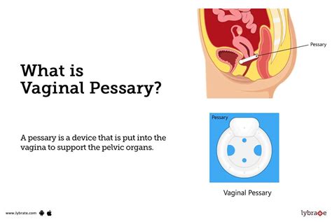 Pessary: Types And How To Use, 49% OFF | www.micoope.com.gt