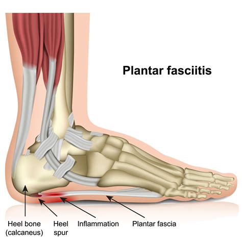 Arch Support For Plantar Fasciitis - JOI Jacksonville Orthopaedic Institute