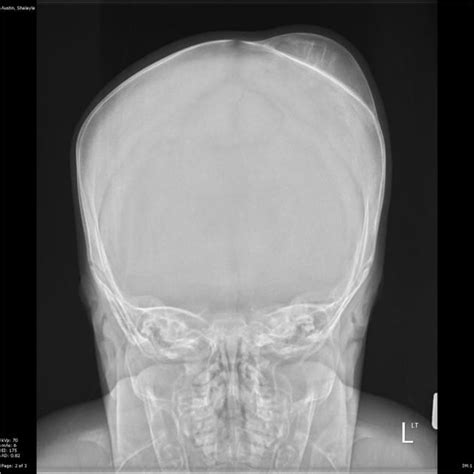 Cephalohaematoma - a classic case containing calcification and bound by ...