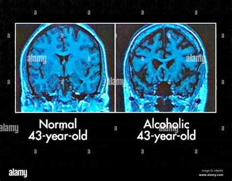 Normal and Alcoholic Brains, MRI Scans Stock Photo - Alamy