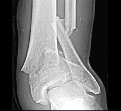 Tibial Plafond Fractures - Trauma - Orthobullets