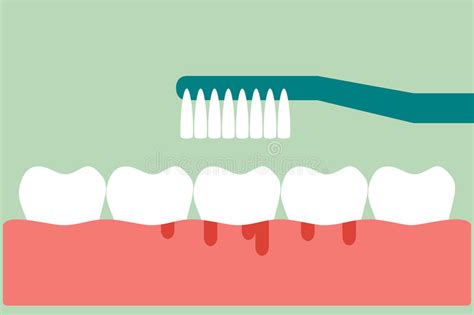 Brushing Teeth with Bleeding on Gum and Tooth Concept Gingivitis or Scurvy Stock Vector ...