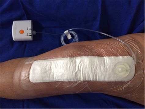 Negative pressure wound dressing medical negative pressure wound therapy