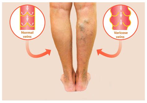 Varicose Veins: Know Your Treatment Options | Vein Clinic