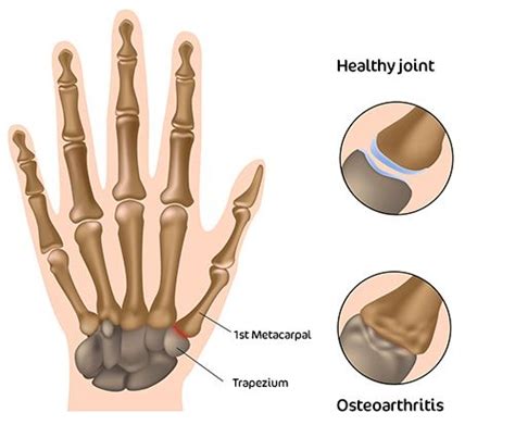 What is CMC Arthritis? - WristSupports.co.uk