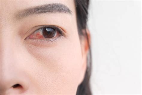 Pink Eye Symptoms You Shouldn't Ignore | Reader’s Digest