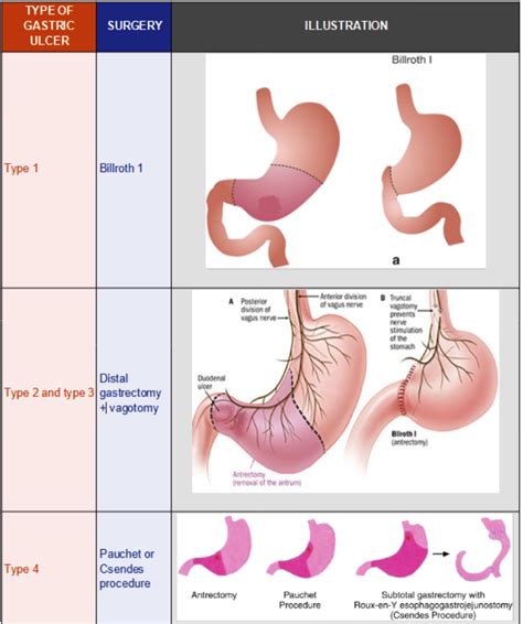 Surgical Management of Gastric Perforation due to Type 1,2,3,4 Gastric ...