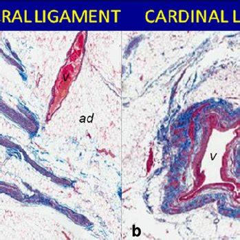 Anatomical synthesis of cardinal (CL) and uterosacral (USL) ligaments ...