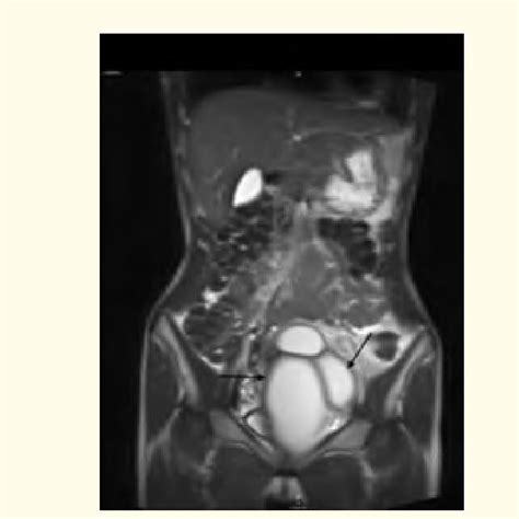 Bicornuate uterus as seen laparoscopically during surgery. Fig. 2.... | Download Scientific Diagram