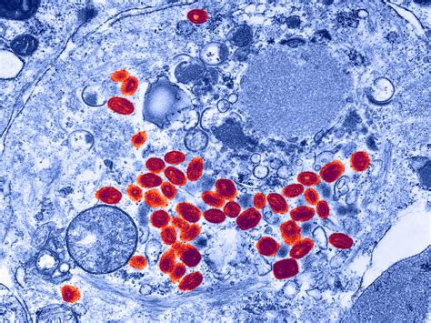 Smallpox Virus Found In Unsecured NIH Lab : Shots - Health News : NPR