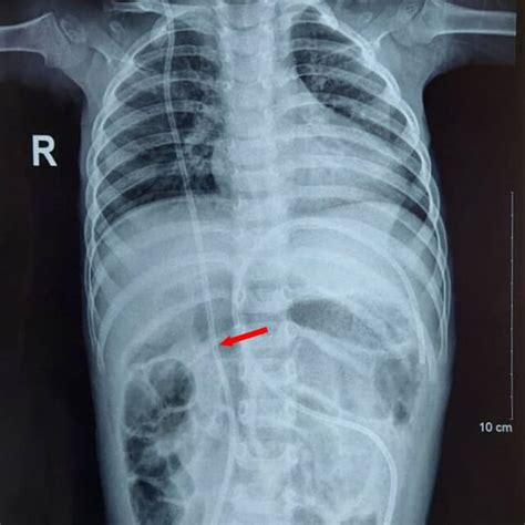 Plain X‐ray chest and abdomen showing VP shunt placement. | Download Scientific Diagram