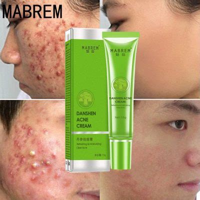 Acne Removal Cream - Pick Click Shop