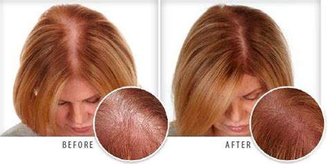 Keranique Hair Regrowth Treatment, Solution & Serum Reviews, Where to ...