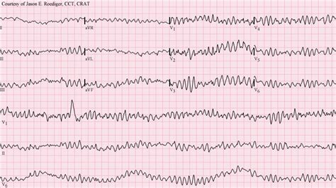 Ventricular Tachycardia Vs Supraventricular Tachycardia