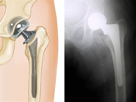 Hip Fracture - Dr. Mukhi’s Raj Hospital