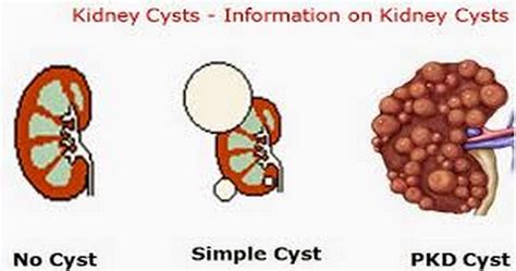 Ask Kidney Doctor: Causes and Symptoms of Kidney Cyst