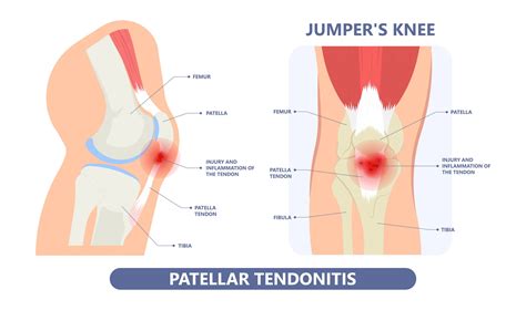 Patellar Tendon surgery - Knee, Hip and Shoulder