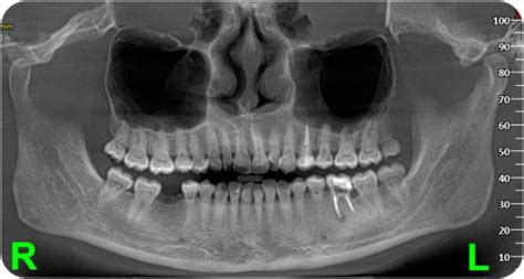 -Orthopantomogram of the same patient after the completion of ...