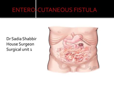 fistula, causes, risks complications.pptx | Free Download