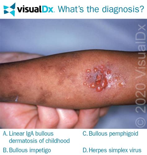 Young Girl Has Multiple Painful, Serpiginous Lesions - Let’s Diagnose | VisualDx