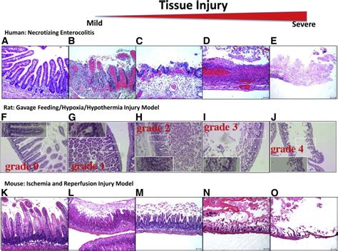 Pathogenesis of Necrotizing Enterocolitis - The American Journal of ...