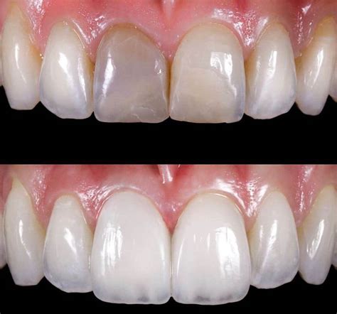 What is the difference between composite veneers and porcelain veneers? | News | Dentagama