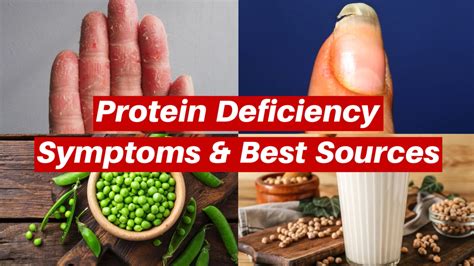 Protein deficiency - what are the symptoms & best sources of Protein?