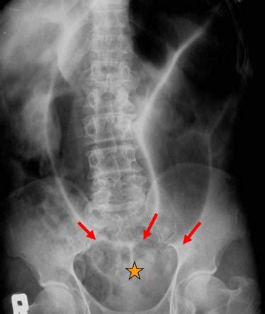 Sigmoid Volvulus Causes