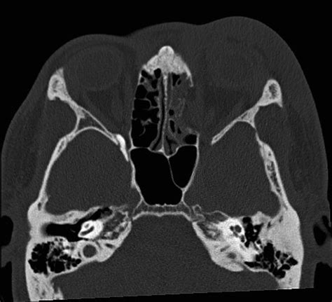 Computed tomography (CT) of traumatic blow-out fracture of medial wall ...