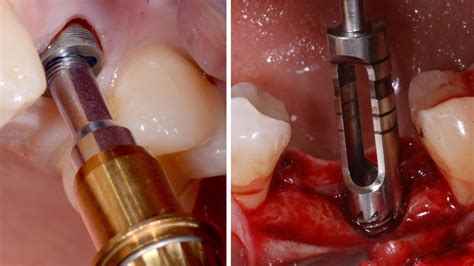 Implant removal. 4 Important factors to know when this is the option. - dentalsurgerychannel.com