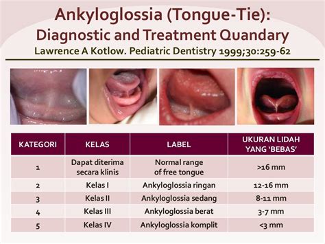 Diagnosis tongue tie & indikasi frenektomi