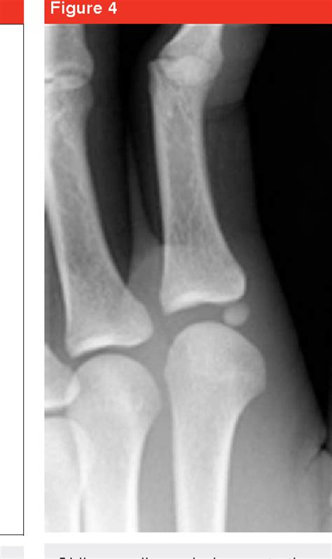 Figure 3 from Metacarpophalangeal joint dislocation. | Semantic Scholar